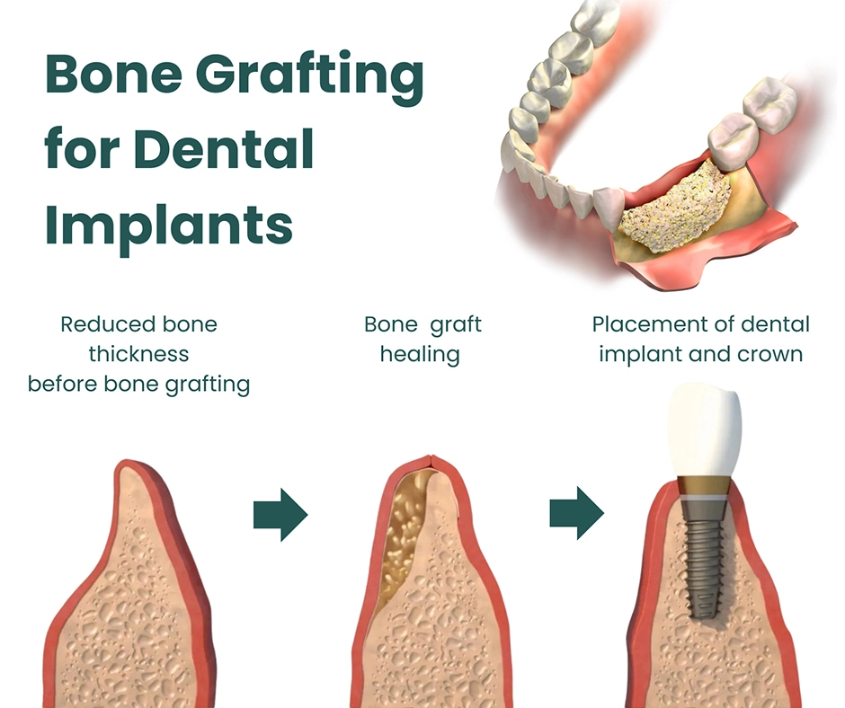 bone grafting procedure