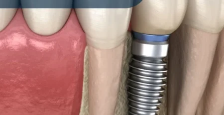 Können Zahnimplantate Knochenabbau verhindern?