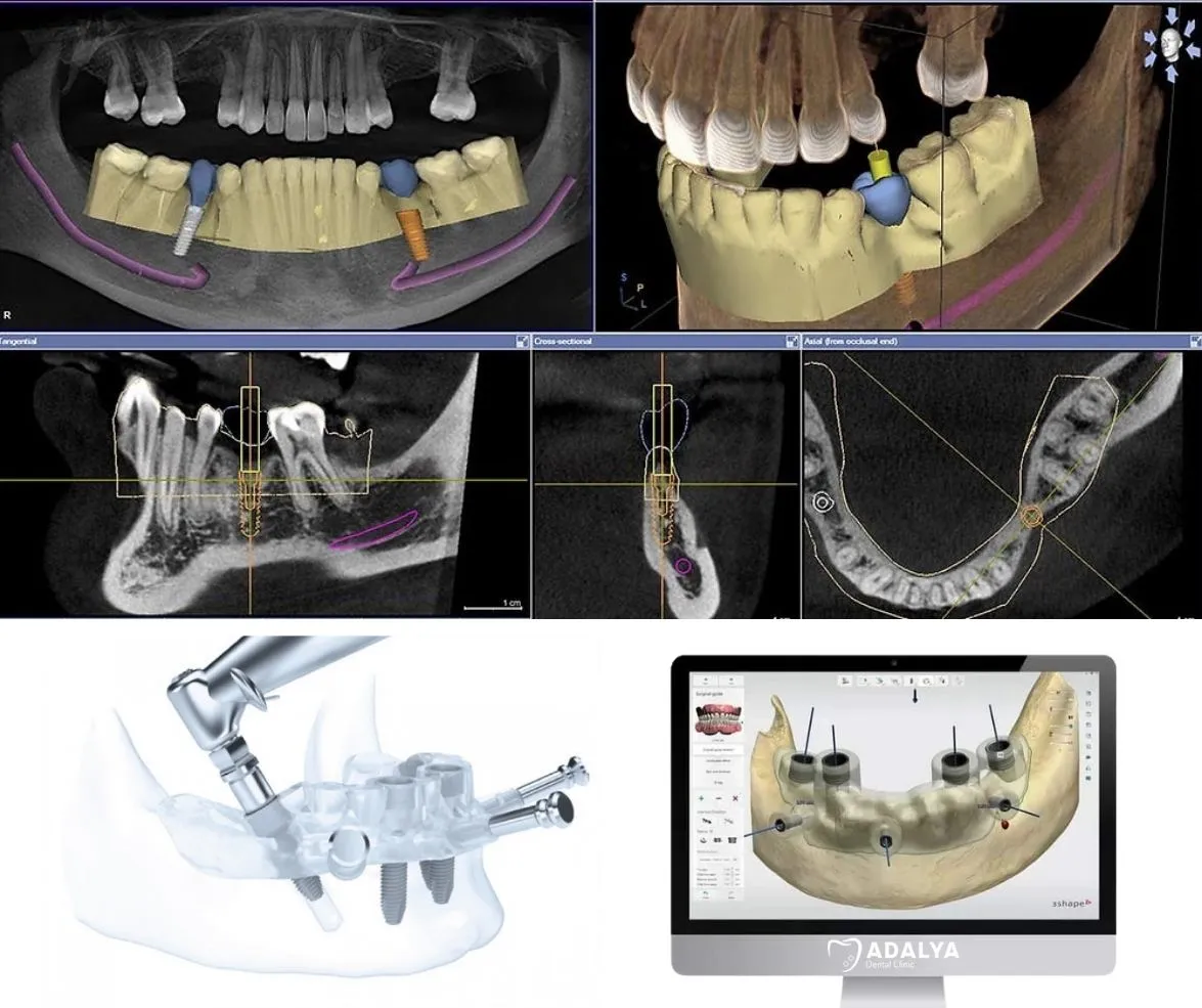 computer guided implants in turkey