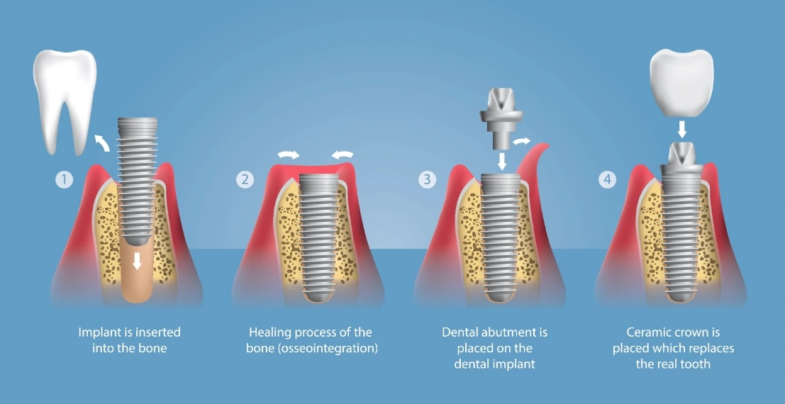 dental implantation stages