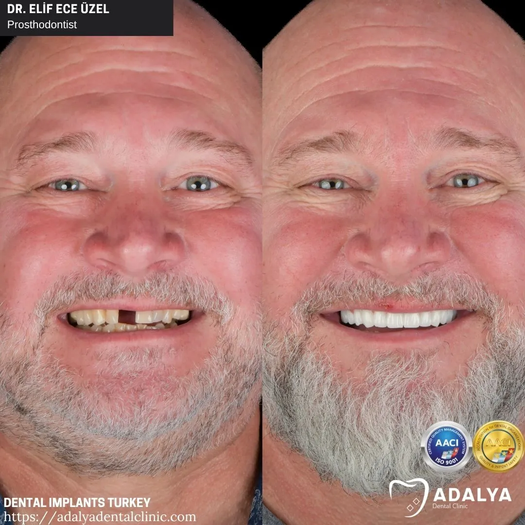 dental implants in turkey