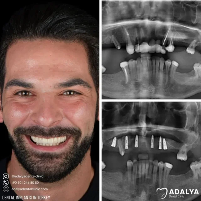 first Turkey visit of patient