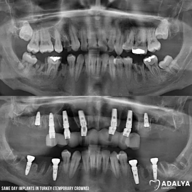immediate temporary crowns after implant surgery