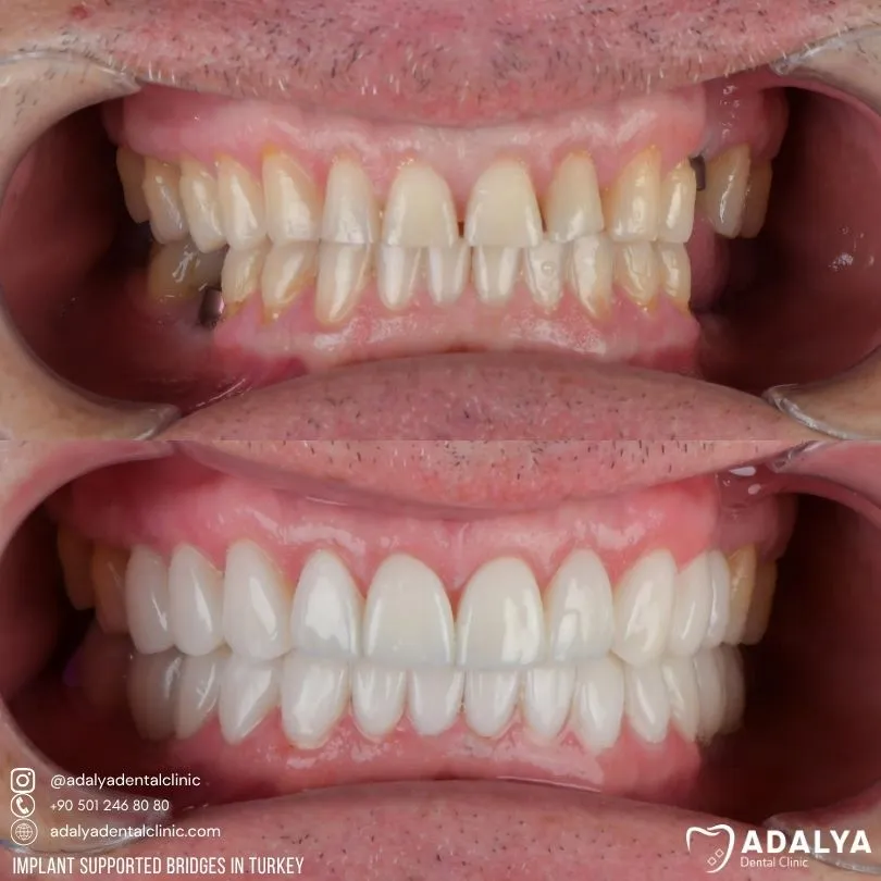 implant supported bridge