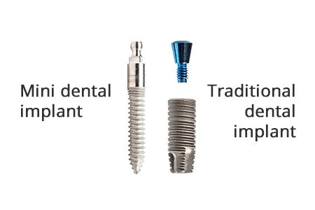 mini dental implant