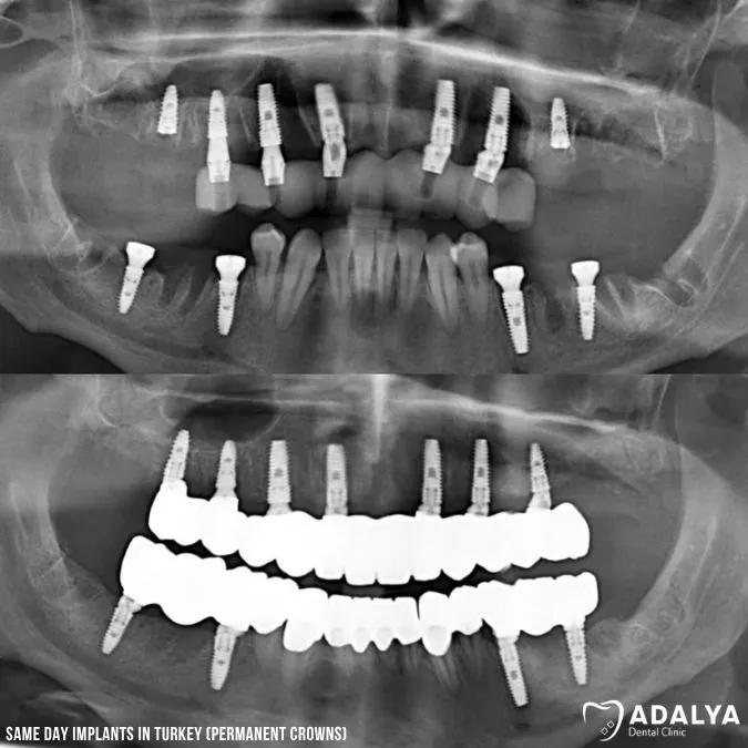 permanent crowns after implant healing