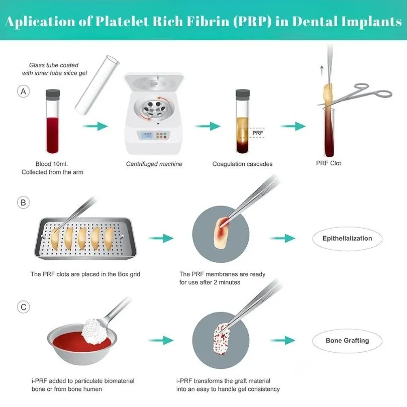 prp for bone grafting in dental implant