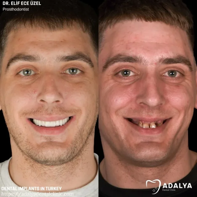 signs that you need dental implant