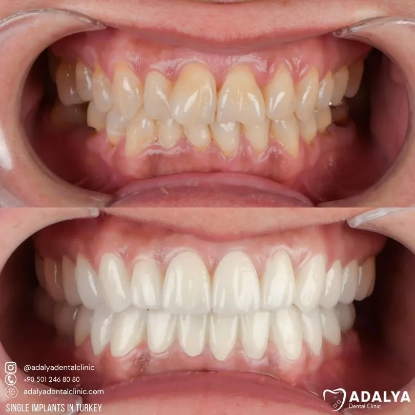single tooth implant