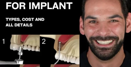 sinus lift for implant