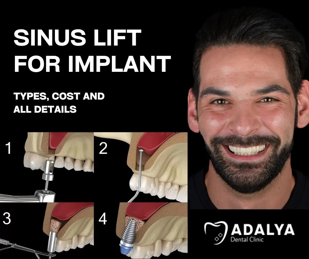 sinus lift for implant
