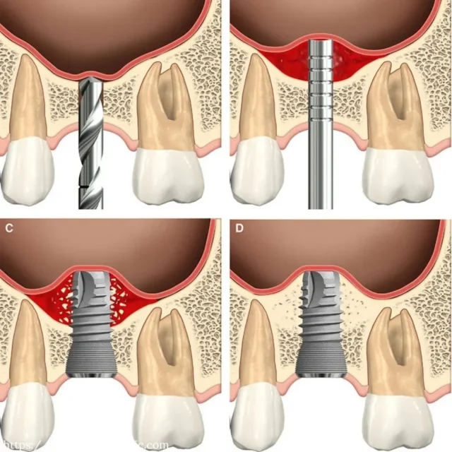 sinus lifting in dental implants