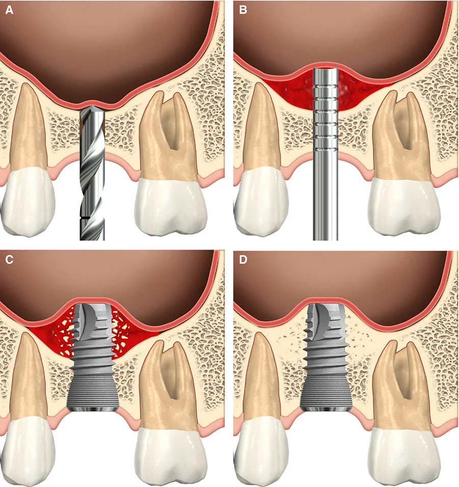 sinus lifting procedure