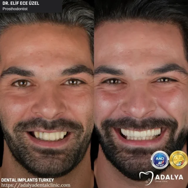 teeth implants turkey
