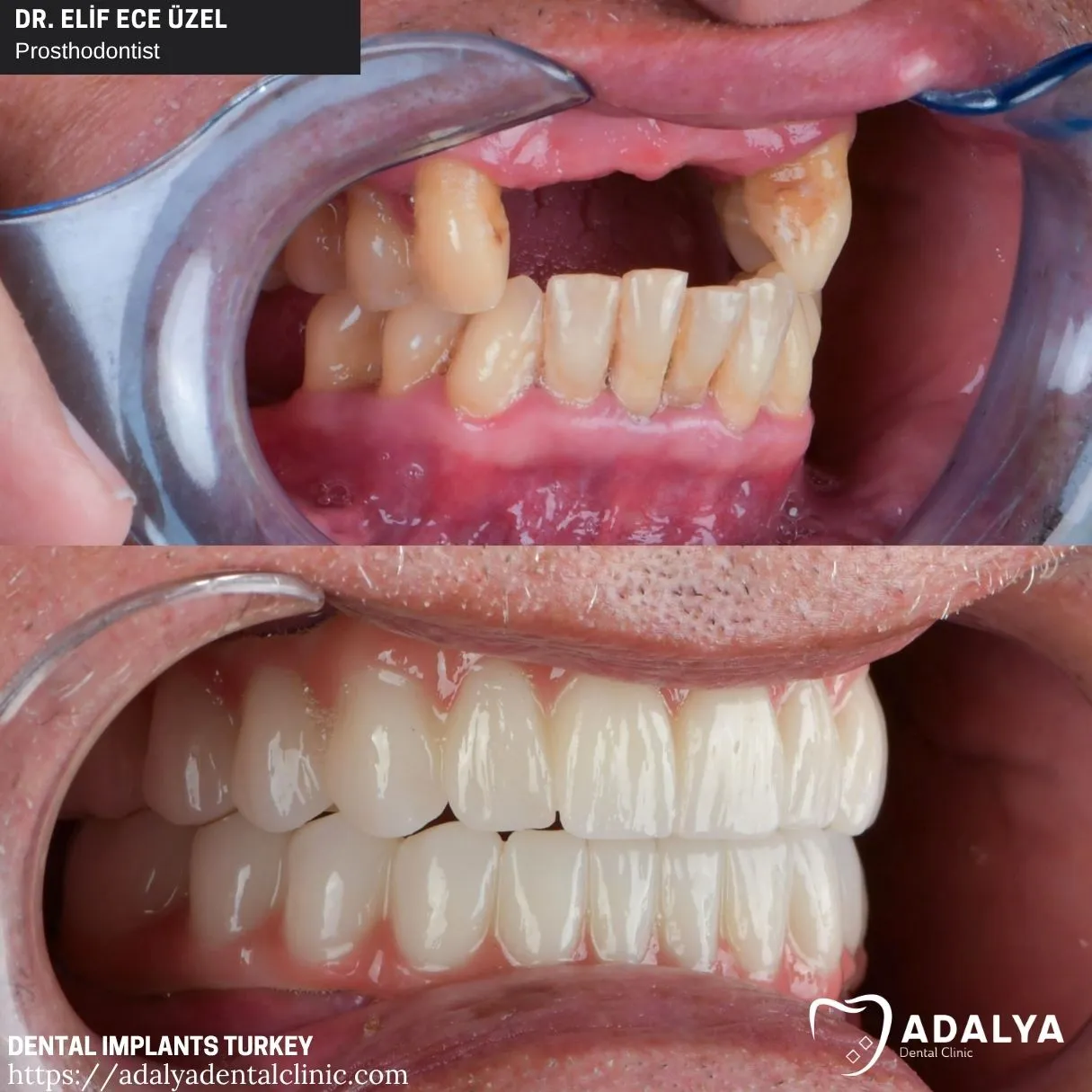 who are good candidate for implants