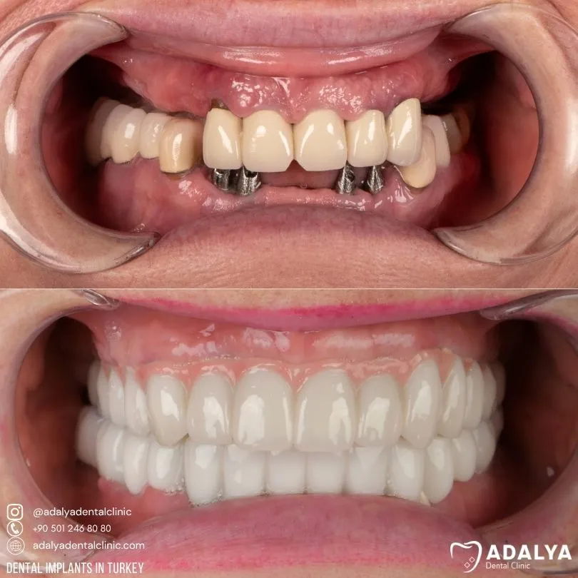 whole mouth implant