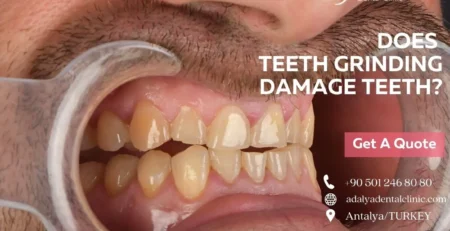 teeth grinding damage