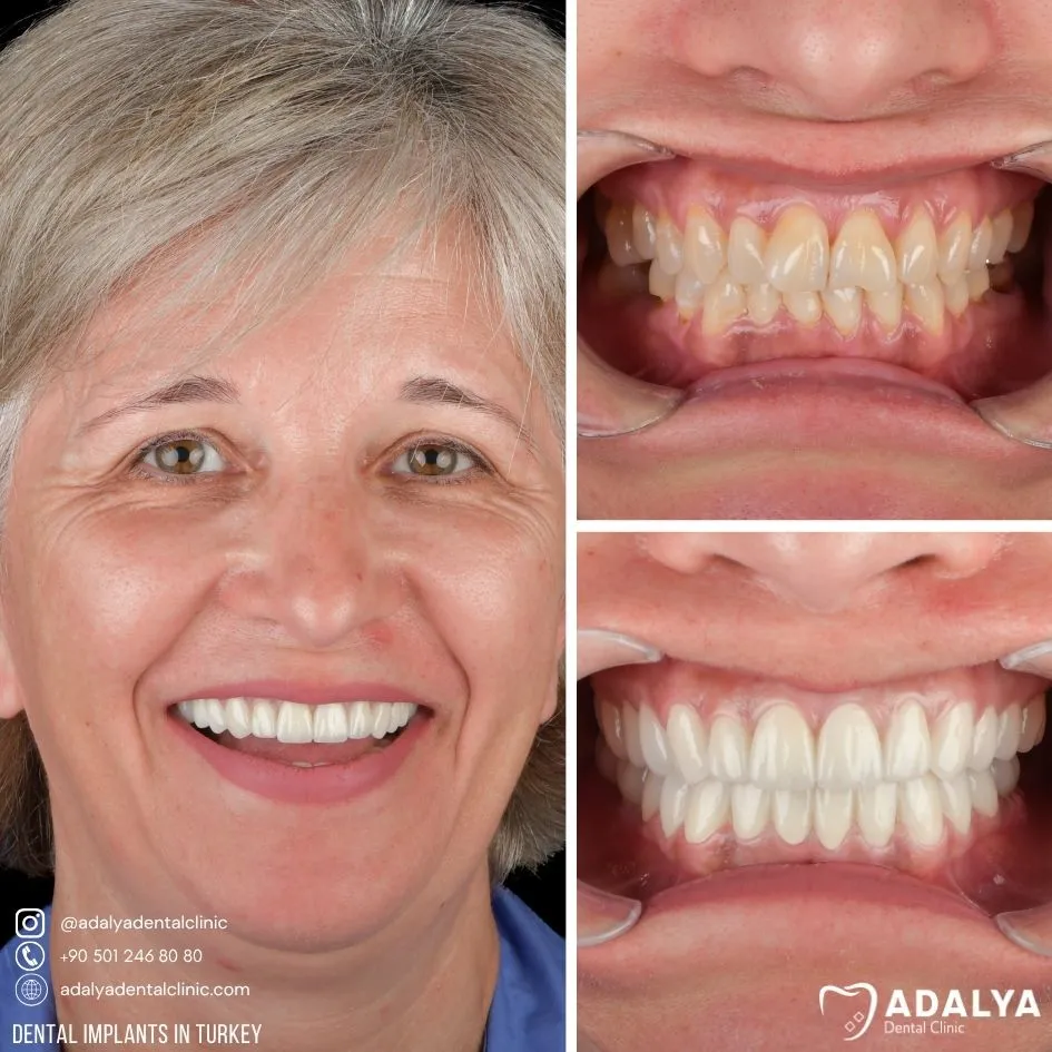 rumenian patient for premium implant brand in turkey