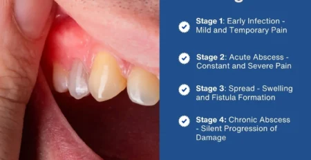 tooth abscess stages