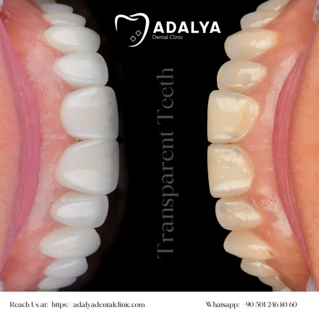 transparent teeth