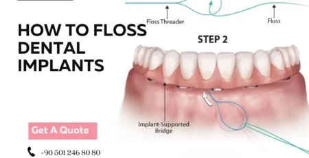 floss dental implants