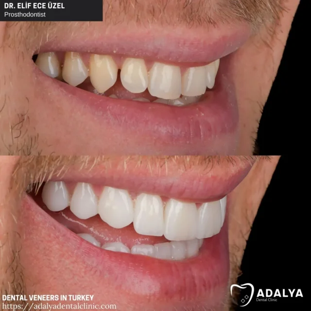 good-veneers-before-and-after good veneers before and after