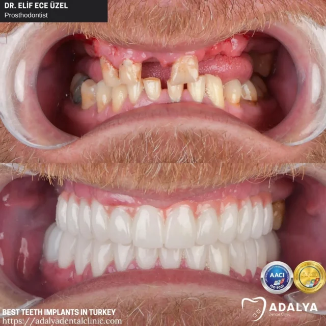 the-best-teeth-implants-in-turkey-antalya the best teeth implants in turkey antalya