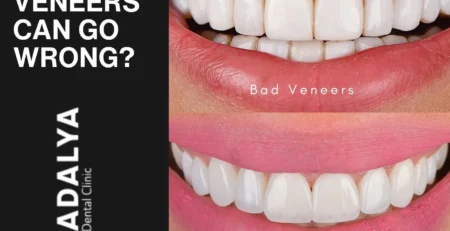 tooth veneers gone wrong