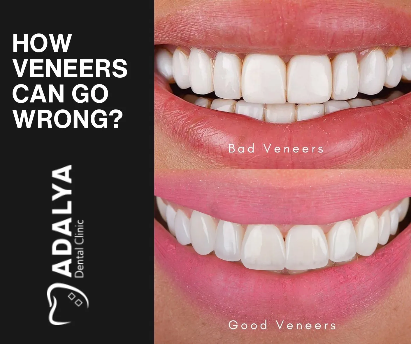 tooth veneers gone wrong