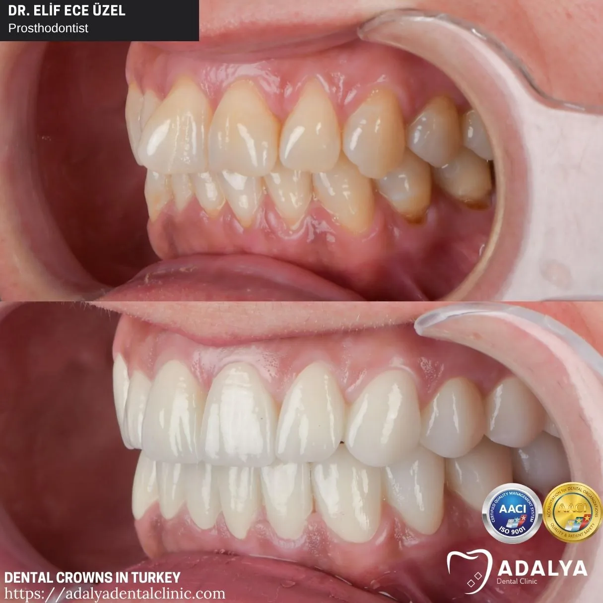 advantages of dental crown holiday in turkey