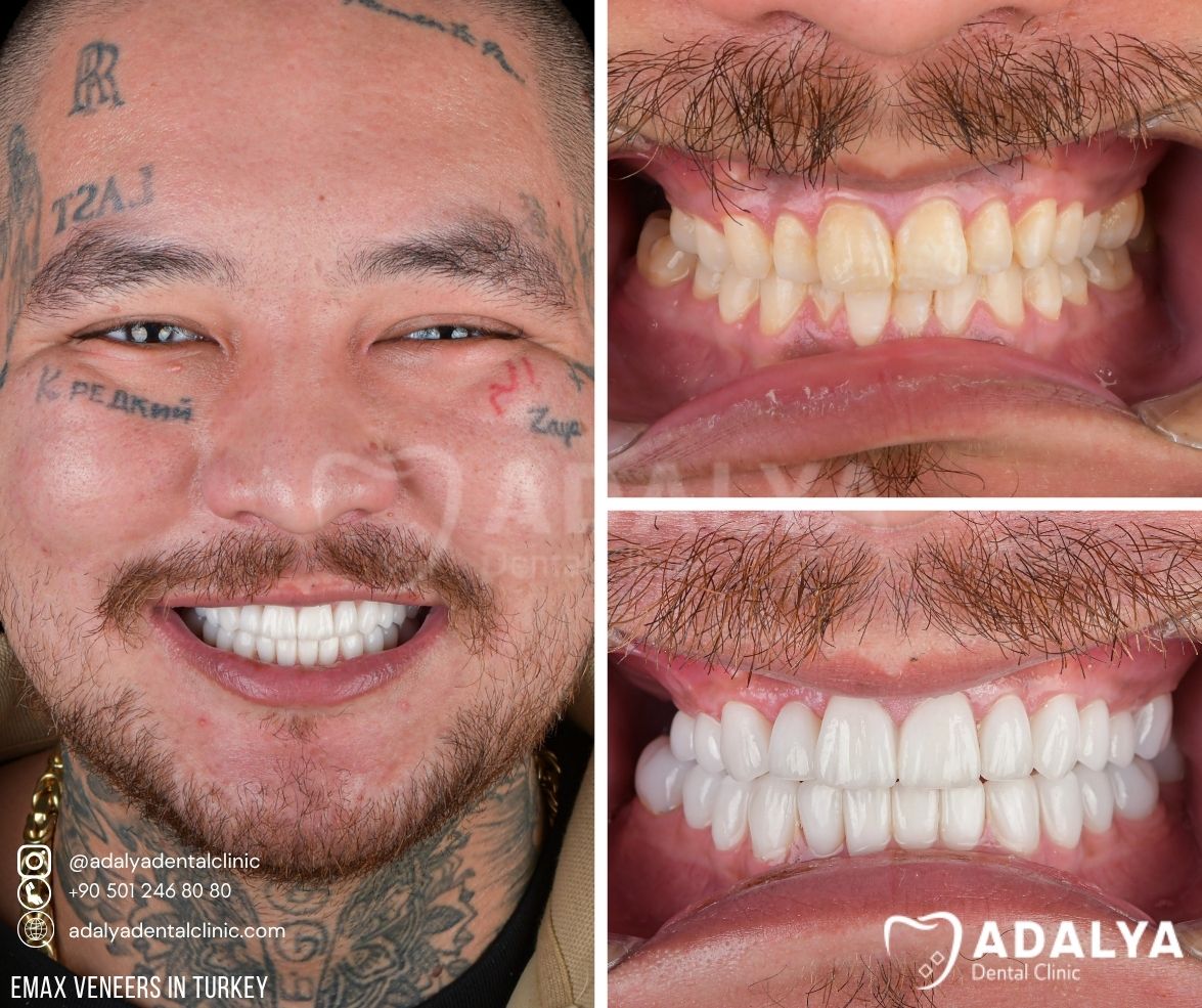 antalya-dentist-prices-turkey-clinic-tooth antalya dentist prices turkey clinic tooth