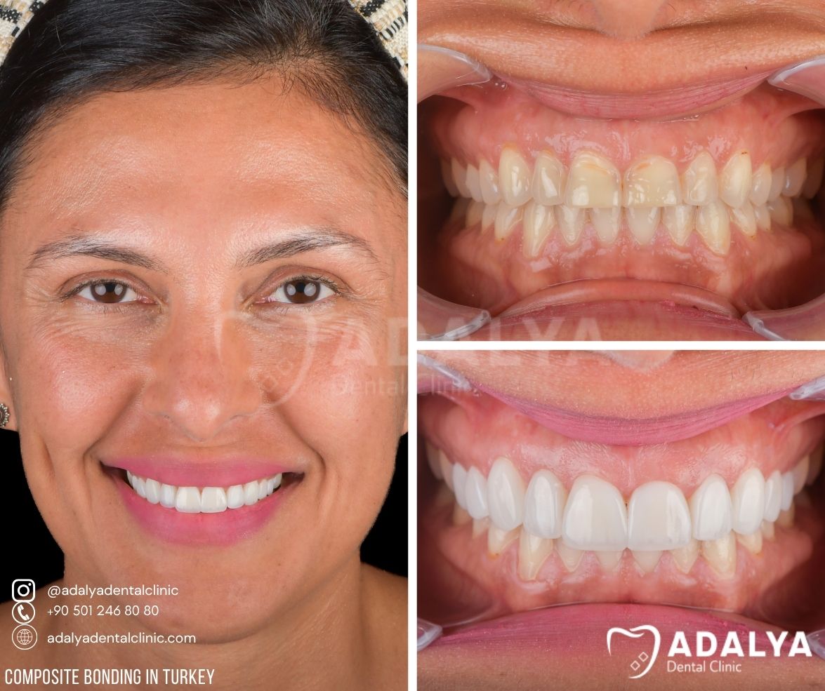 antalya turkey tooth prices dental centre