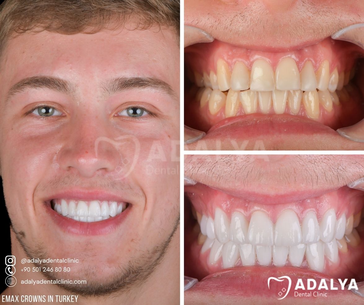 emax teeth crown prices in turkey antalya