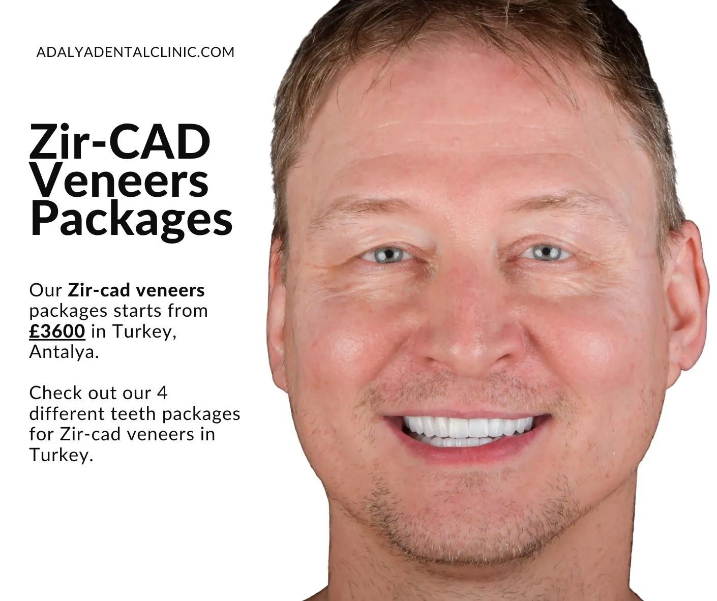 emax-zircad-prime-veneer-package-deals-in-turkey-antalya emax zircad prime veneer package deals in turkey antalya