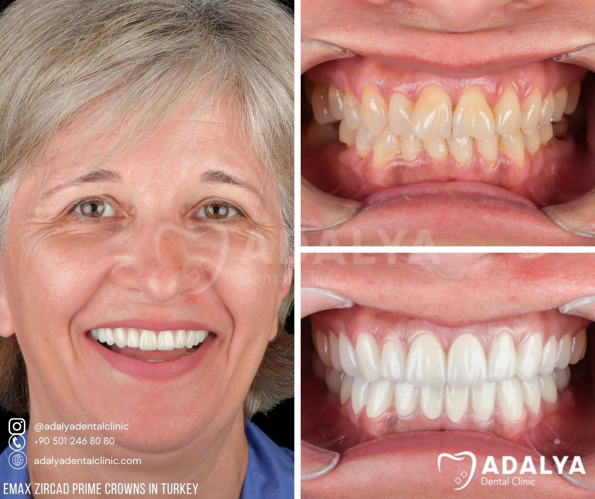 emax zircad prime veneer prices in turkey antalya