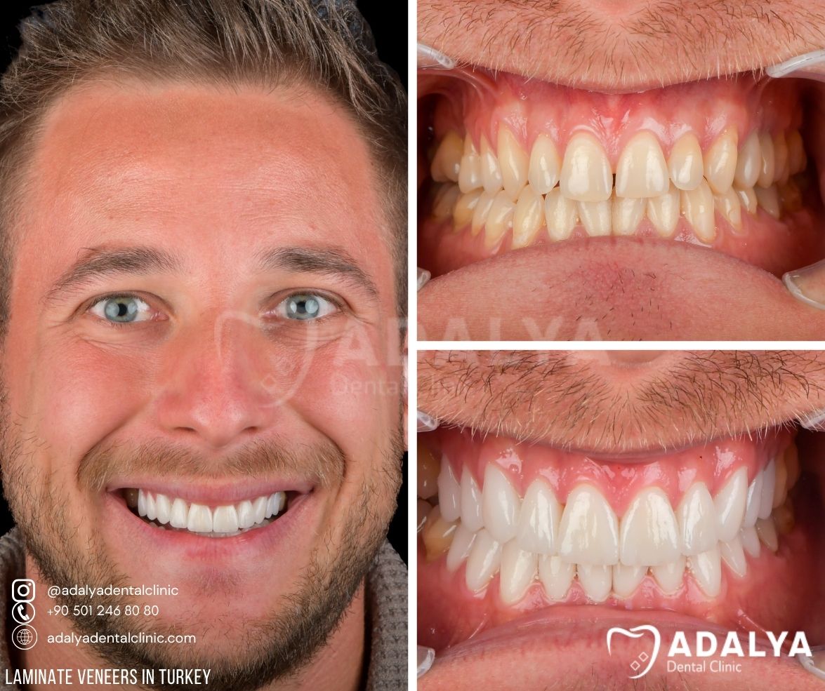 laminate-teeth-veneer-prices-in-turkey laminate teeth veneer prices in turkey