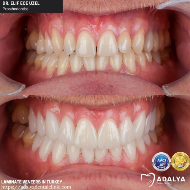 laminate-veneers-in-antalya-turkey-adalya-clinic laminate veneers in antalya turkey adalya clinic