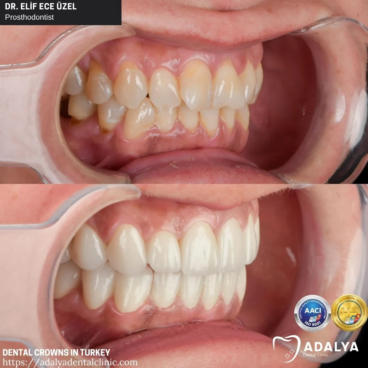 suitable cases for teeth crowns
