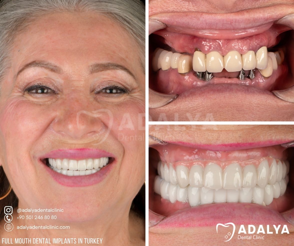 teeth treatments prices in turkey antalya