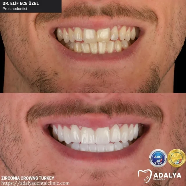 turkey dental crowns antalya packages