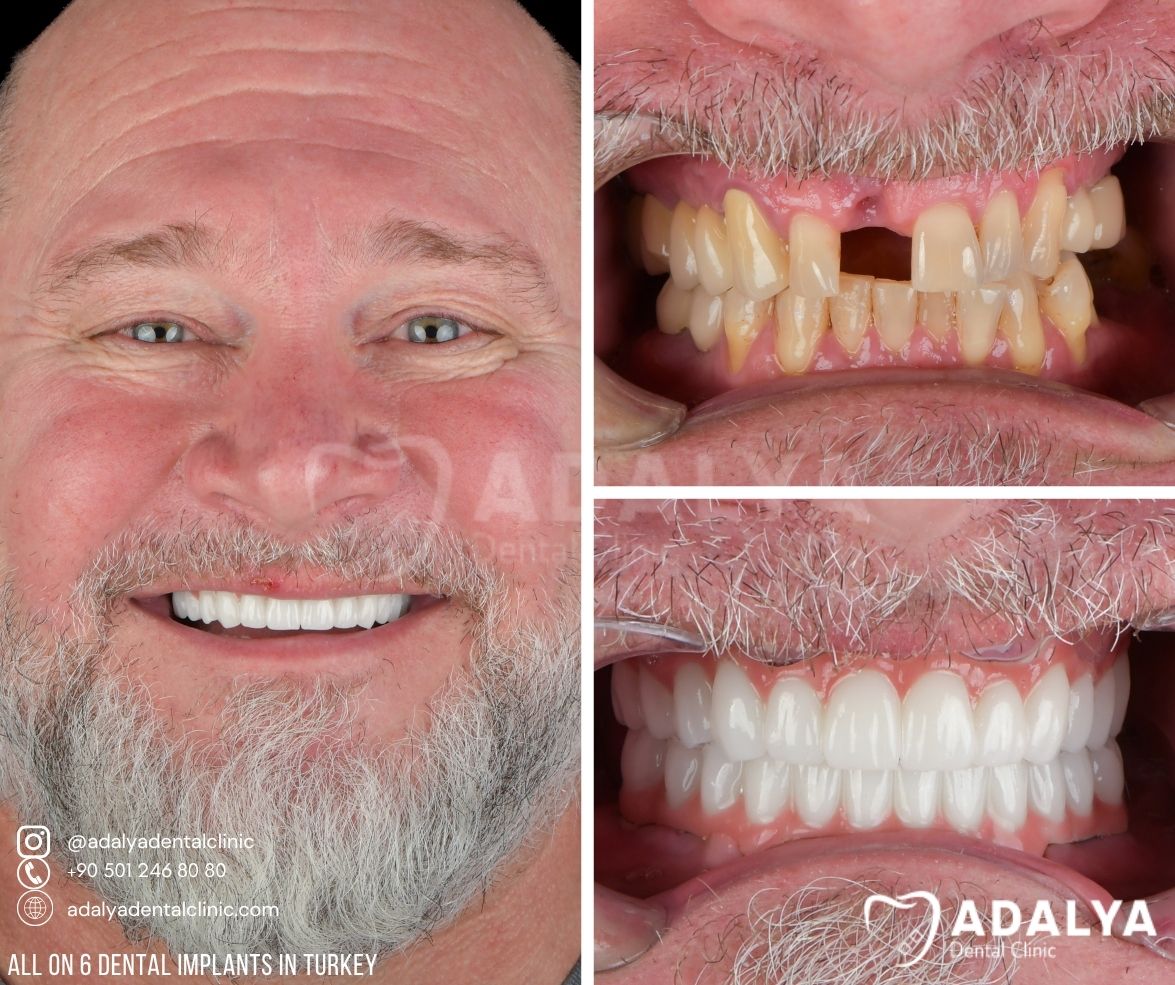 turkey dentist prices adalya dental center