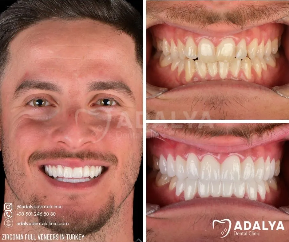veneers-turkey-package-price-antalya veneers turkey package price antalya