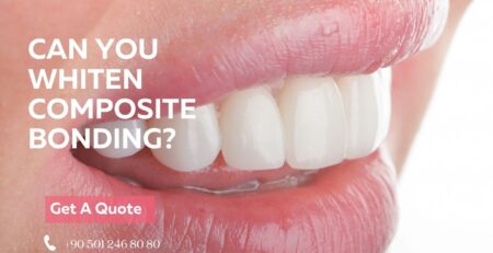 can you whiten composite bonding