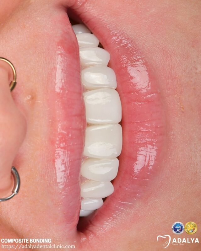 can you whiten composite bonding teeth