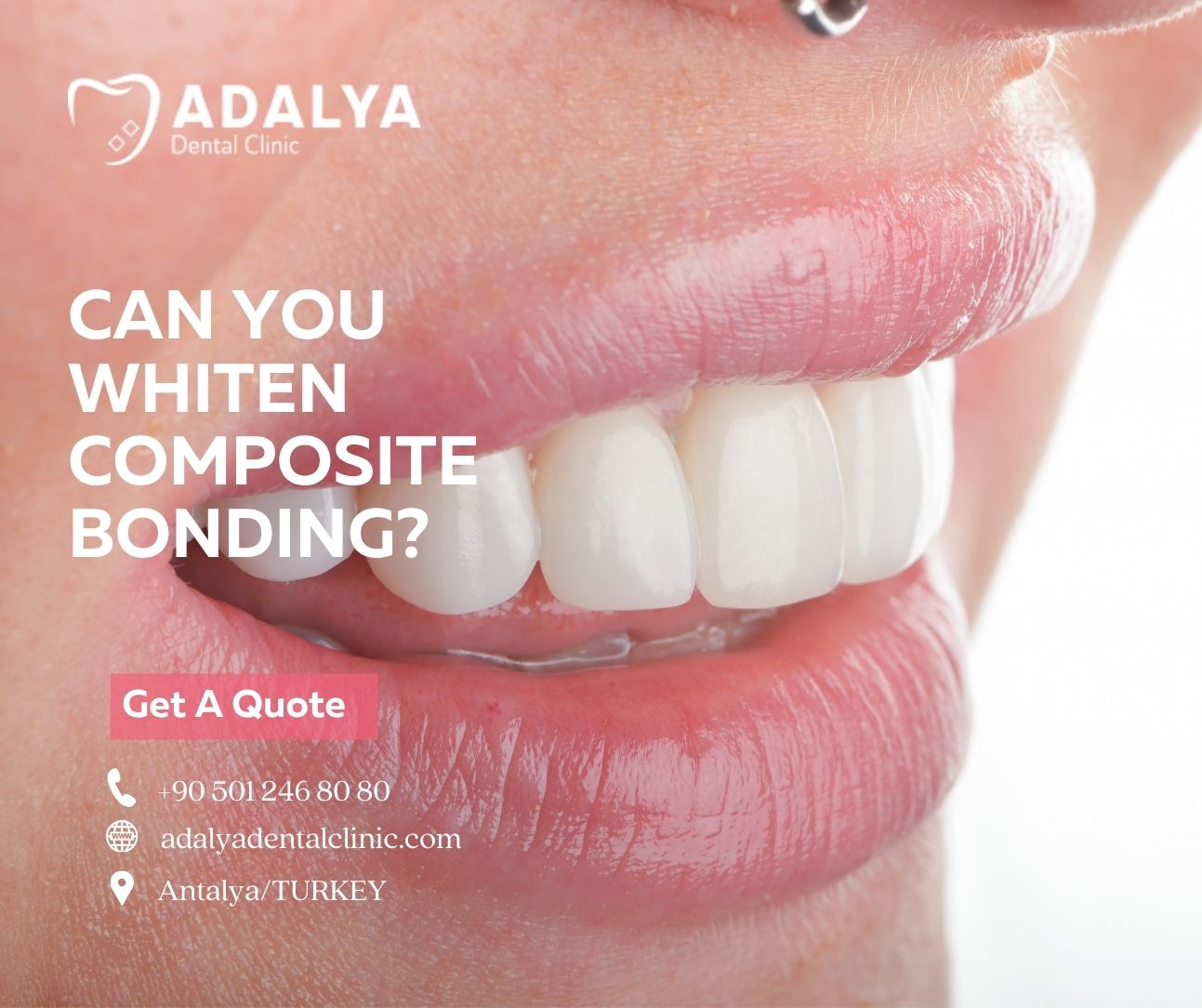 can you whiten composite bonding