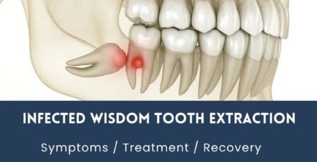 infected wisdom tooth extraction