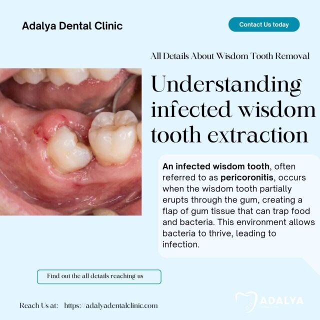 infected wisdom tooth removal