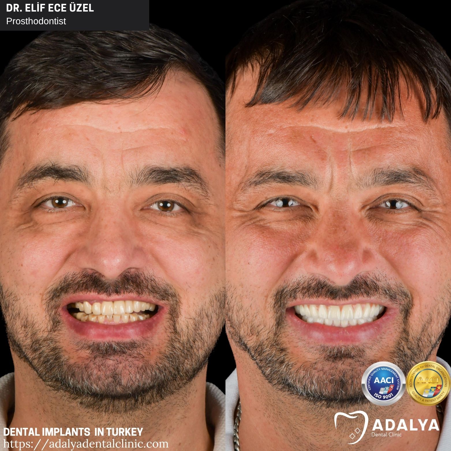 adalya teeth implant turkey antalya
