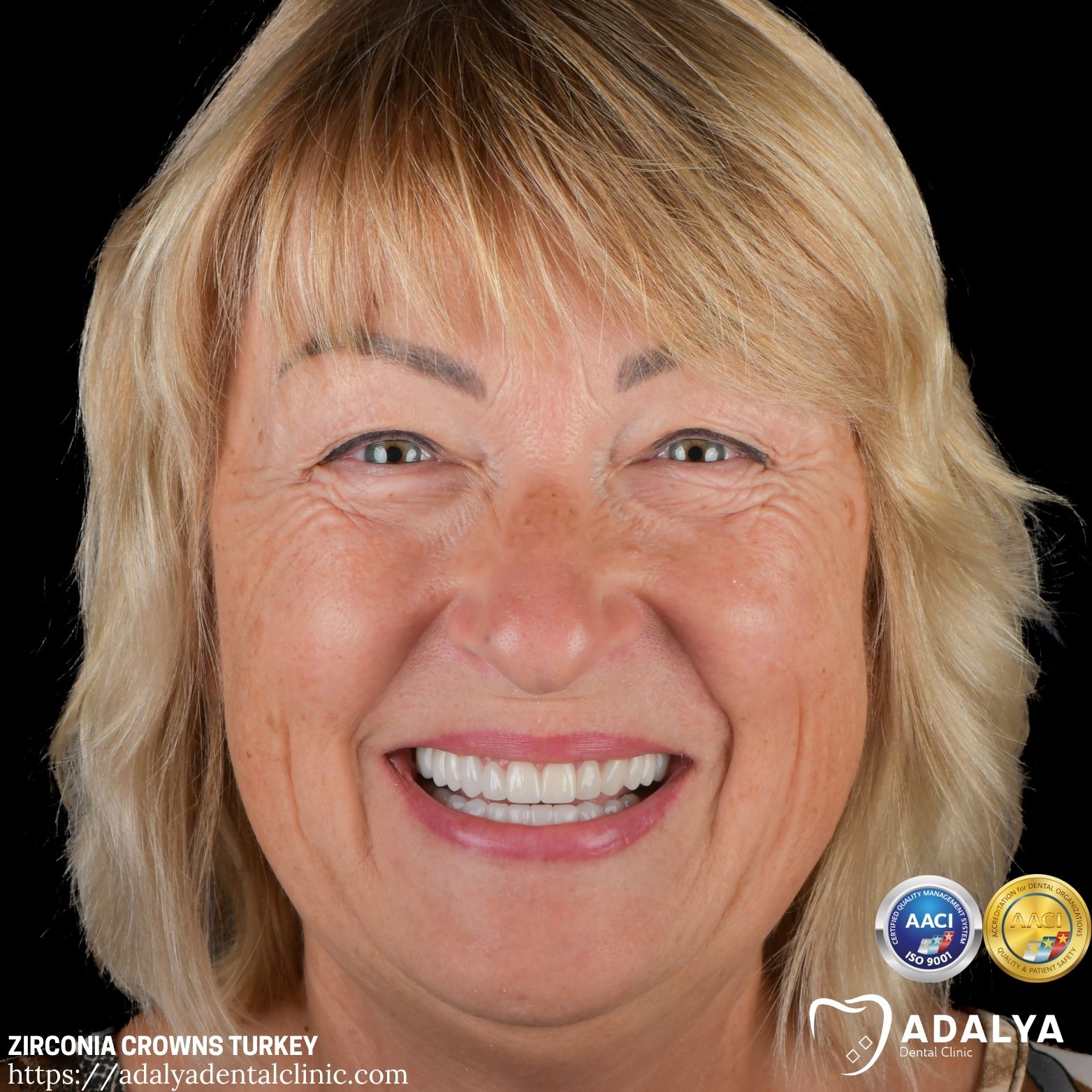 adalya zirconium full veneers antalya turkey