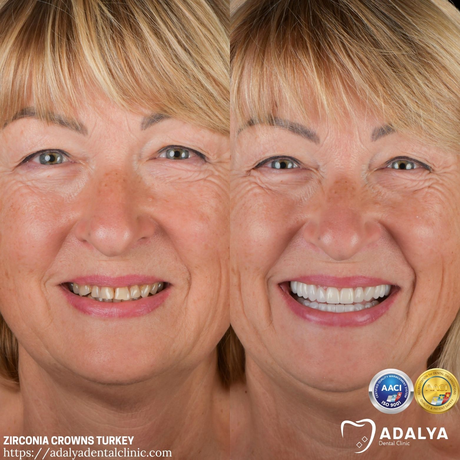 adalya zirconium full veneers turkey antalya